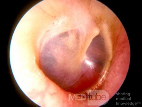 Glomus Jugulare Tumor