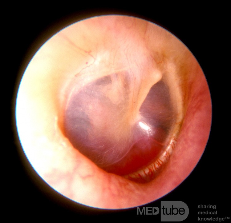 Glomus Jugulare Tumor