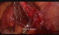 Laparoscopic Surgery for Endometrioma