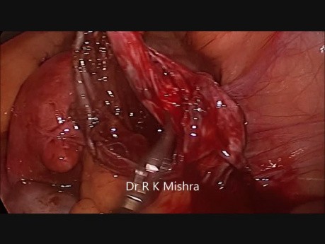 Laparoscopic Surgery for Endometrioma