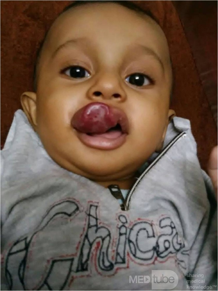 Strawberry Hemangioma 