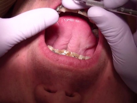 Orthodontics Case #1 - Currently 10 Months In Fixed Ortho Appliances