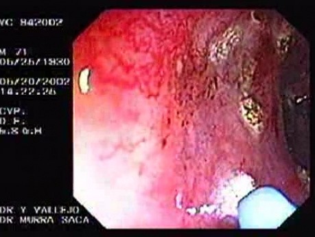 Radiation Proctosigmoiditis (11 of 14)