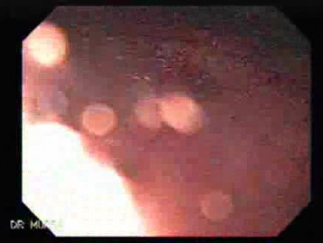 Hiatal Hernia - Retroflexed Meneuver - 2