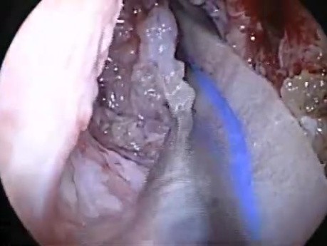 Brainstem Decompression by the Use of Endoscopic Transnasal and Intraoral Approach