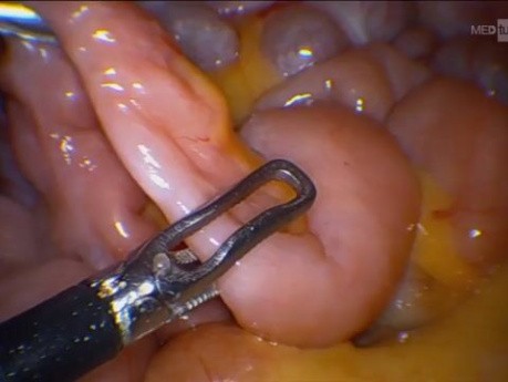 Laparoscopic Retrieval of Endoscopy Capsule