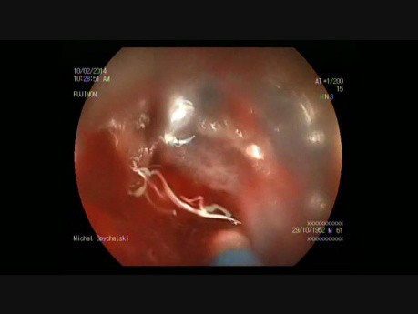 Endoscopic Submucosal Dissection of Rectosigmoid Tumor