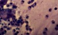 Cervicitis - Clue cells