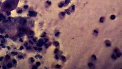 Cervicitis - Clue cells