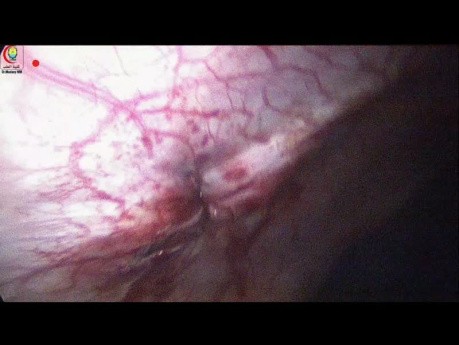 Nasr Fascial Closure Device for Multiple Suture for Large Port Site Size