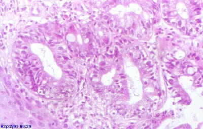 Barrett's Ulcer (4 of 5 )