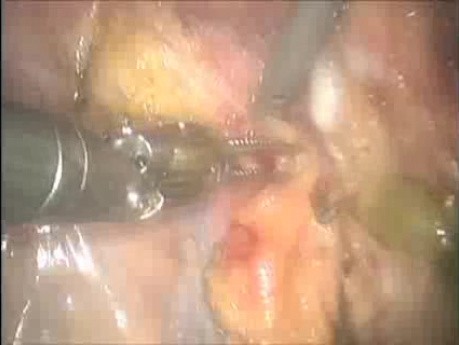 Intersphincteric Dissection Followed by Robotic Abdominoperineal Resection for Anterior Rectal Cancer