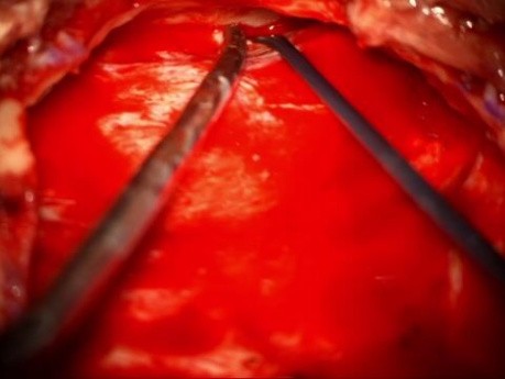 Left Middle Fossa Approach for Resection of Metastatic Cavernous \ MC Lesion  