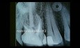 Periodontal Microsurgery: Extraction and Bone Grafting Site Preparation for Molar Implant Restoration