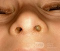 Unilateral Rhinorrhea From Nasal Foreign Body
