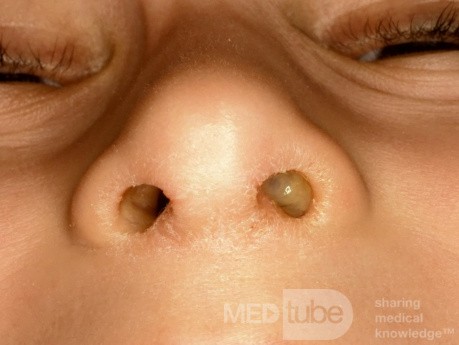 Unilateral Rhinorrhea From Nasal Foreign Body