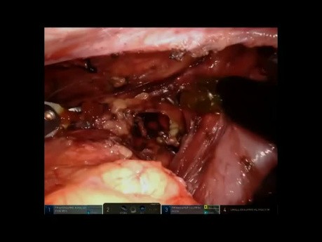 Robotic Transhiatal Esophagectomy (SESC 2021)