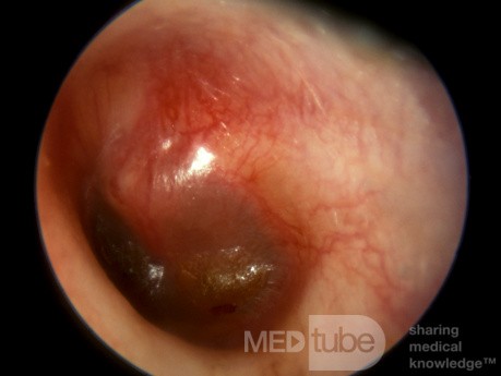 Acute Otitis Media