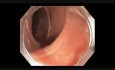 Colonoscopy Channel - Subtle Flat Lesion