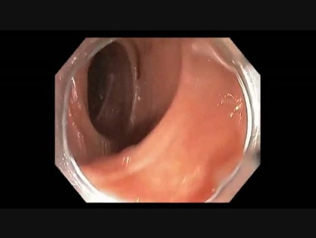 Colonoscopy Channel - Subtle Flat Lesion