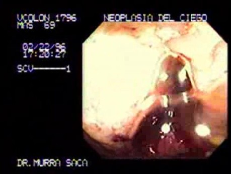 Endoscopy Of Adenocarcinoma Of The Cecum (2 of 2)