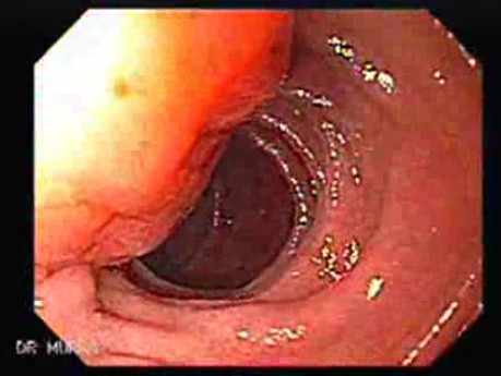 Adenocarcinoma of Papilla of Vater (1 of 5)