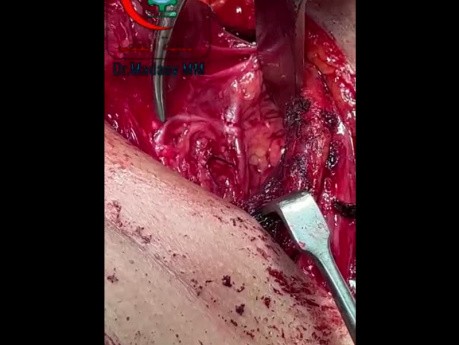 Extralaryngeal Branching of the Recurrent Laryngeal Nerve