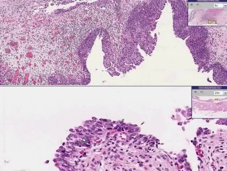 Bladder - Urothelial Carcinoma (Transitional Cell Carcinoma) In-Situ