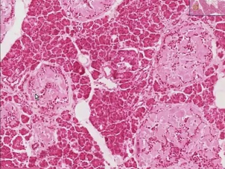Type 2 Diabetes mellitus