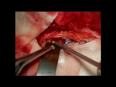 CNS Lymphoma