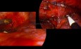 Recurrent TE Fistula after EA-TEF Repair