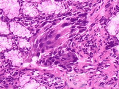 Ovarian Carcinoma Metastatic to Stomach and Duodenum (14 of 20)
