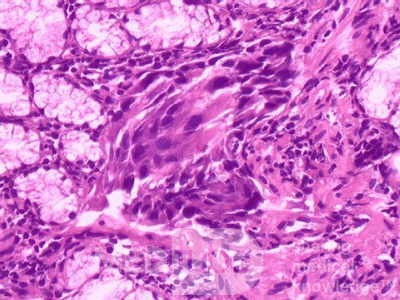 Ovarian Carcinoma Metastatic to Stomach and Duodenum (14 of 20)