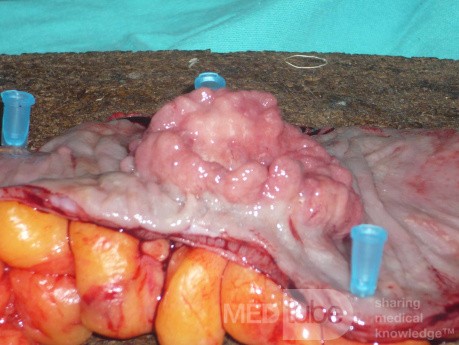 Colon Adenocarcinoma, Villous Adenocarcinoma (8 of 12)