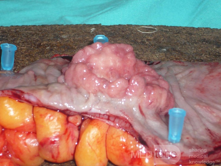 Colon Adenocarcinoma, Villous Adenocarcinoma (8 of 12)
