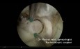 Challenging hysteroscopic myomectomy with the resecare*