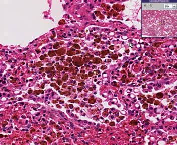 Lung - Chronic Pulmonary Congestion