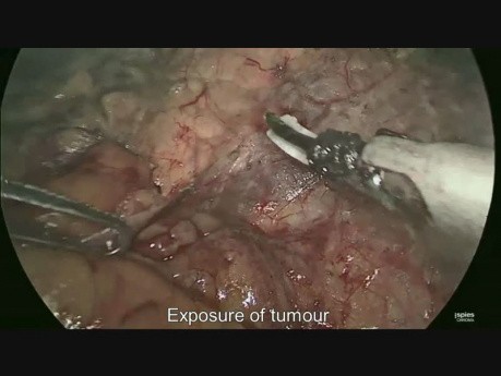 Laparoscopic Management of a Case of Functioning Adrenal Pheochromocytoma