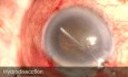 Spontaneous Maliganant Glaucoma During Phacotrabeculectomy