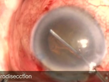 Spontaneous Maliganant Glaucoma During Phacotrabeculectomy