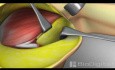 Mastectomy