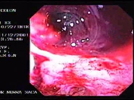 Diverticular Disease - Hemorrhage (5 of 15)