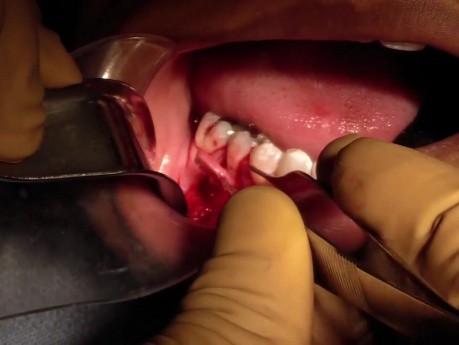 Part 4/8: Root Coverage Surgery - Mandibular Premolar - Placement Into Recipient Site