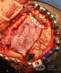 Surgical Planning with Neuronavigator in Patient with Intracranial Mass Lesion. High Grade Glioma.