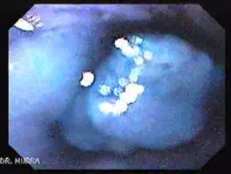 Chromoendoscopy Of The Esophagus - Magnified Multi-lobulated Papilloma - 3/4