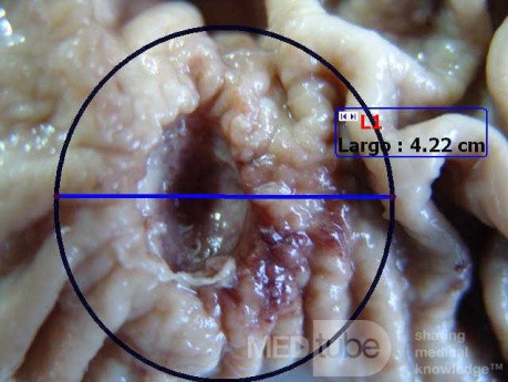 Adenocarcinoma of the Antrum and incisura angularis (8 of 12)