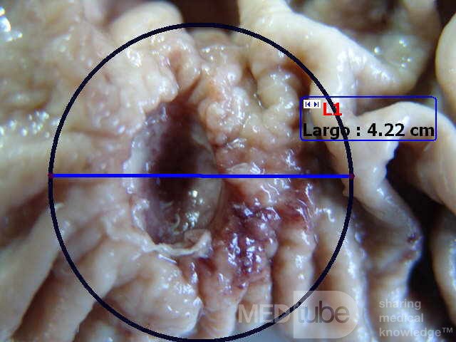 Adenocarcinoma of the Antrum and incisura angularis (8 of 12)