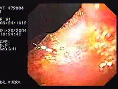 Giant Gastric Ulcer - Endoscopy (2 of 5)