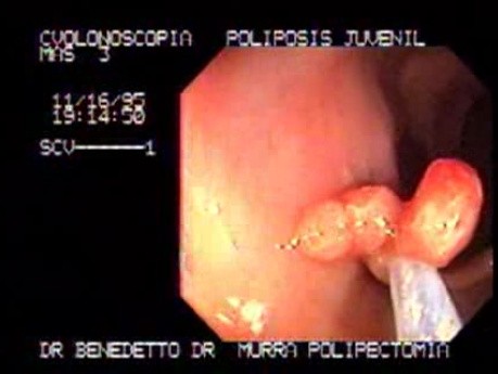 Non Familial Juvenile Polyposis Of The Colon (9 of 37)