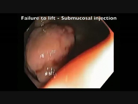 Endoscopic Signs Of Cancer In a Flat Lesion 